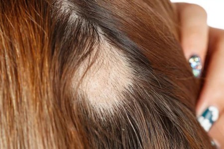 Pulling Your Hair Out? For Some, the Struggle Is Real