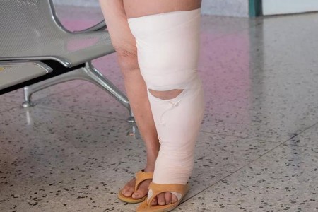 What You Should Know About Swelling in Your Legs
