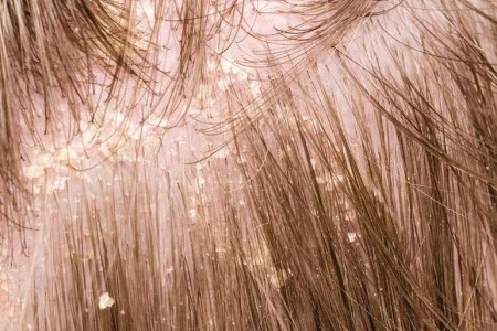 What’s Best for Dandruff That Won’t Go Away?