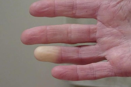 My Hands and Feet Are Always Cold — Should I Worry?