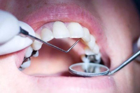 Should You Worry About Mercury in Your Silver Dental Fillings?