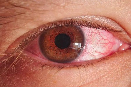 Why is Pink Eye More Common In Winter?