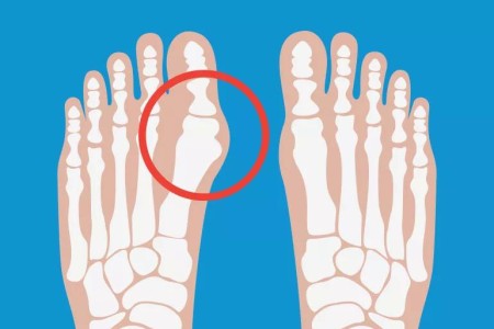 When Should I Have Surgery for My Bunions?