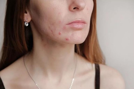 Are Thyroid Issues Causing Your Acne?