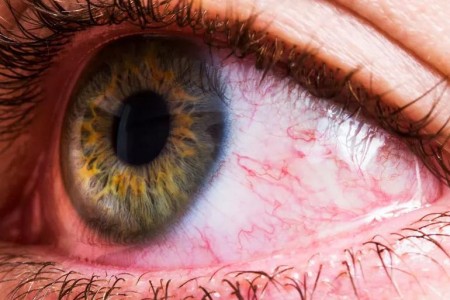 Itchy, Red Eyes? How to Tell If It’s Allergy or Infection