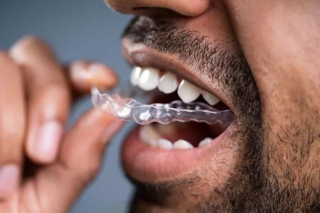 Should You Use a Dental Mouthguard for Your Jaw Pain?