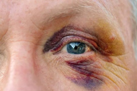 How To Get Rid of a Black Eye