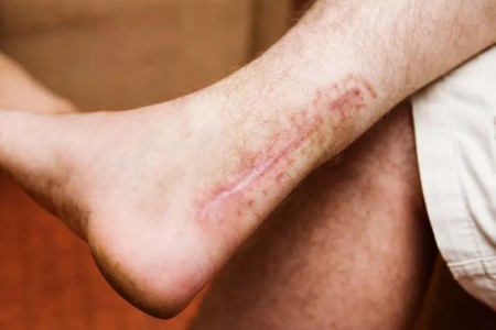 How to Prevent Scarring