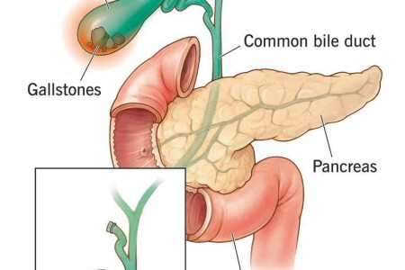 Cholecystectomy (Gallbladder Removal)