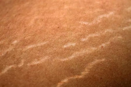 What You Should Know About Stretch Marks on Your Breasts