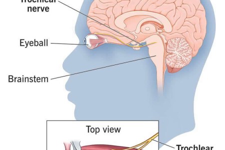 Trochlear Nerve