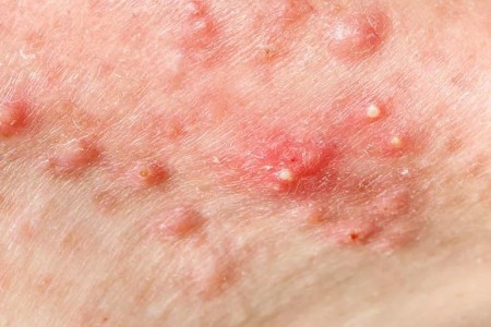 Do Home Remedies for Cystic Acne Work?