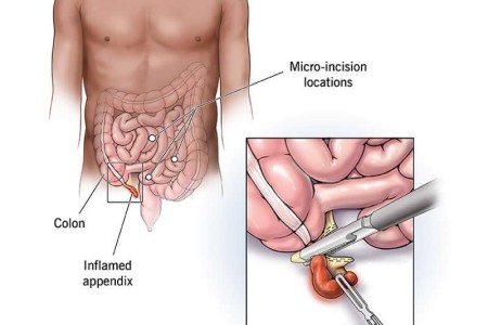 Appendectomy