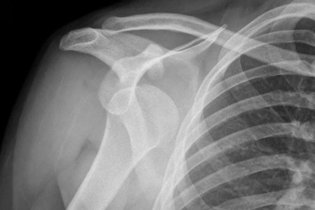 Shoulder Dislocation: How It Happens + 5 Things To Do if You Suspect It