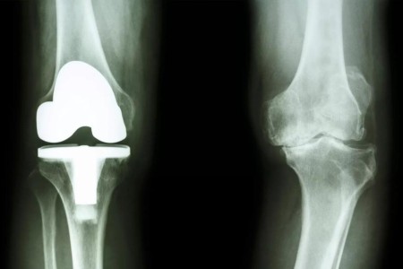 4 Ways to Prevent Prosthetic Joint Infection