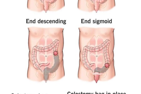 Colostomy