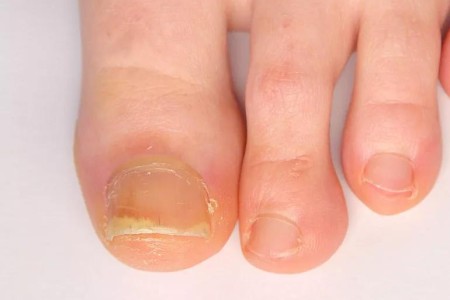 How Does Psoriatic Arthritis Affect Your Nails?