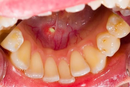 When That Pain in Your Mouth Is a Salivary Stone