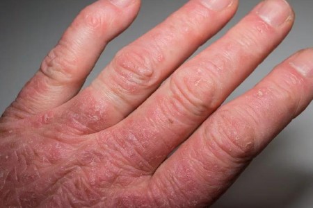 Psoriatic Arthritis vs. Rheumatoid Arthritis
