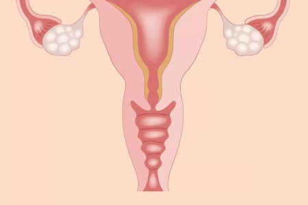 Signs You Have an Ovarian Cyst — and What To Do About It