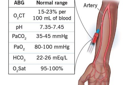 Arterial Blood Gas (ABG)