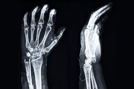 Wrist X-Ray