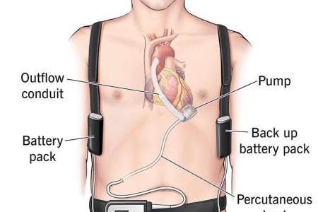 Ventricular Assist Devices