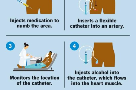 Alcohol Septal Ablation