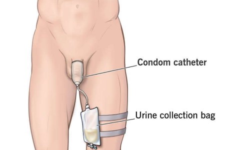 Condom Catheter for Incontinence