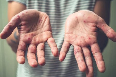 Can Adults Get Hand, Foot and Mouth Disease?