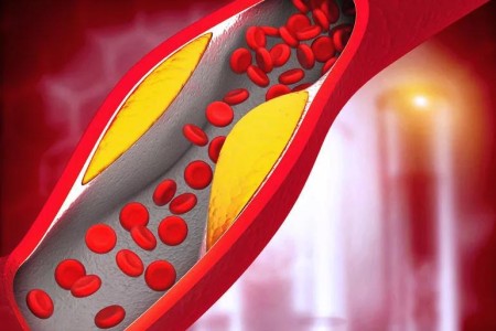 Is High Cholesterol Hereditary?