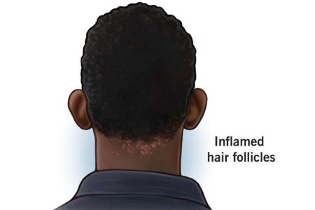 Acne Keloidalis Nuchae