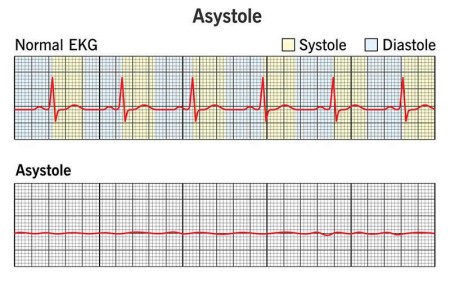Asystole