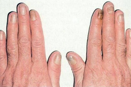 Yellow Nail Syndrome