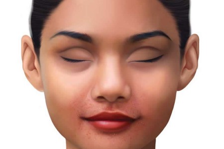 Yeast Infection on Face