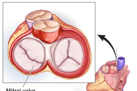 Mitral Valve
