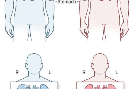 Situs Inversus