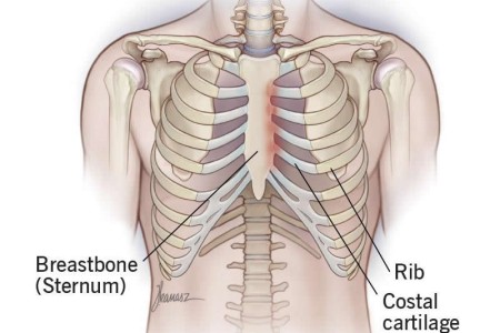 Tietze Syndrome