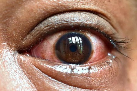 Why Ankylosing Spondylitis Causes Eye Pain