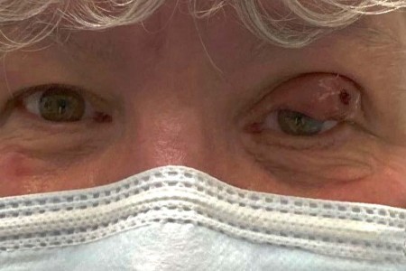 Periorbital (Preseptal) Cellulitis