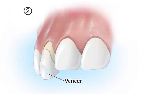 Veneers