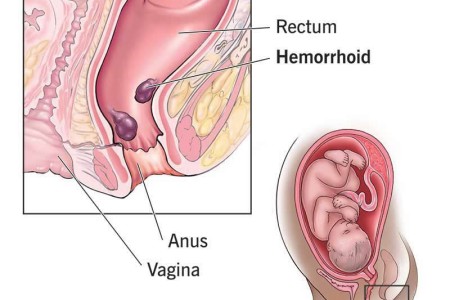 Hemorrhoids During Pregnancy