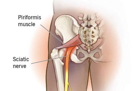Piriformis Syndrome