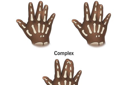 Syndactyly (Webbed Toes or Fingers)