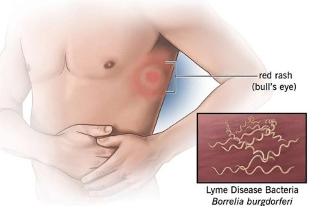 Lyme Disease