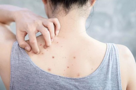 Does Working Out Help Acne? What Experts Say