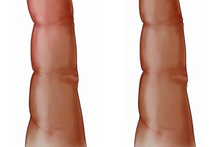 Clubbed Fingers