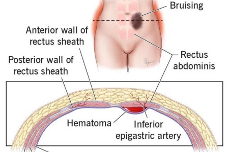 Rectus Sheath Hematoma