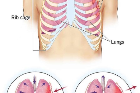 Flail Chest
