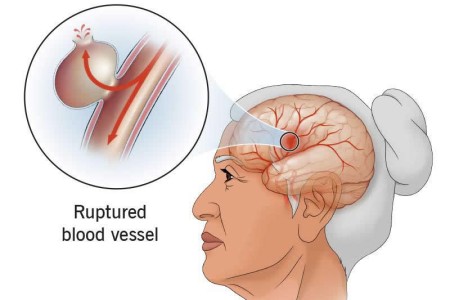 Hemorrhagic Stroke